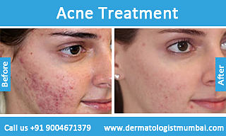 Avail the best Acne Treatment - Dermatologistmumbai.com .jpg